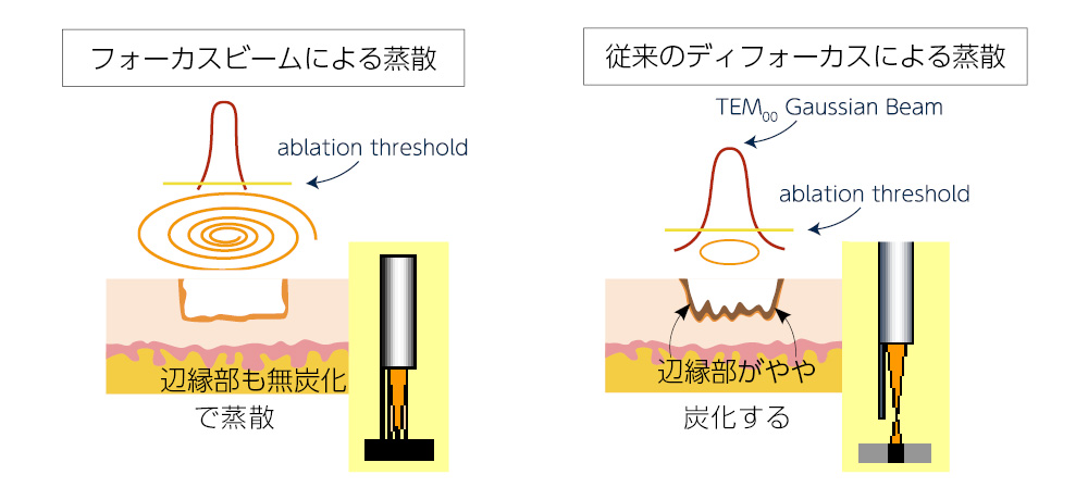 特徴②キレイに削ることができ、傷跡が最小限になりやすい　イメージ