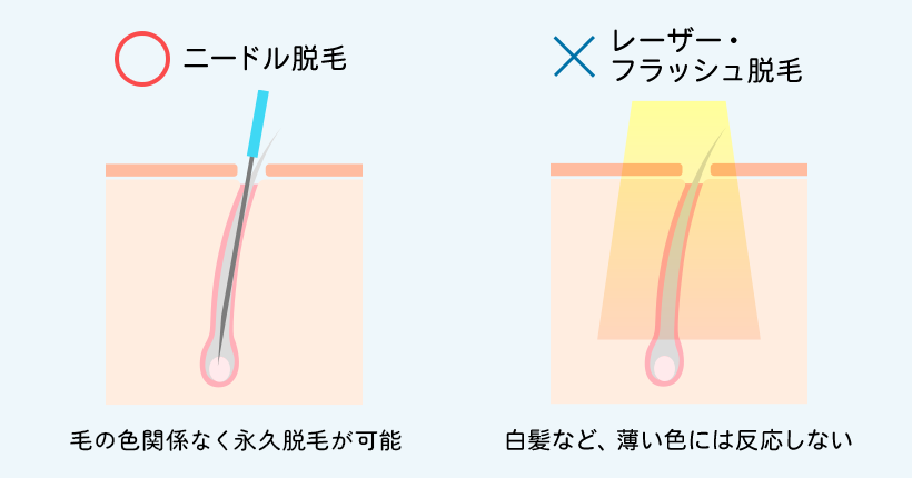 ニードル脱毛とは