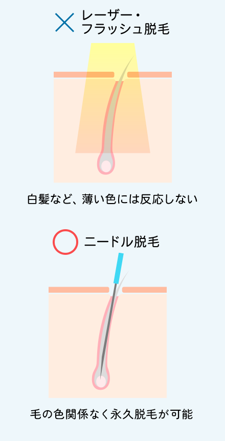 ニードル脱毛とは