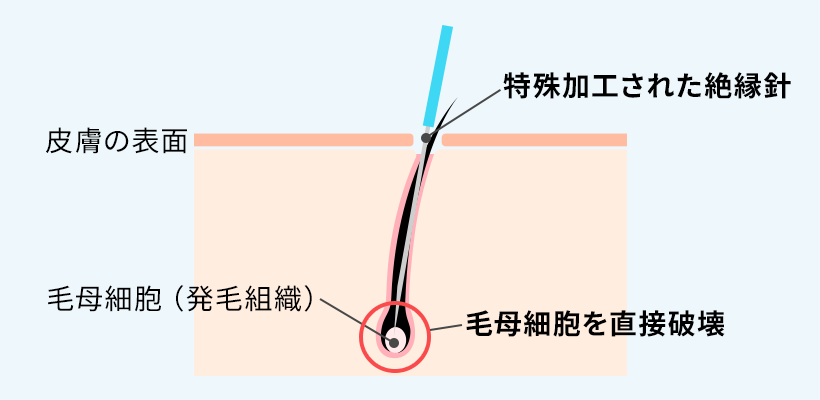 ニードル脱毛の原理と仕組み
