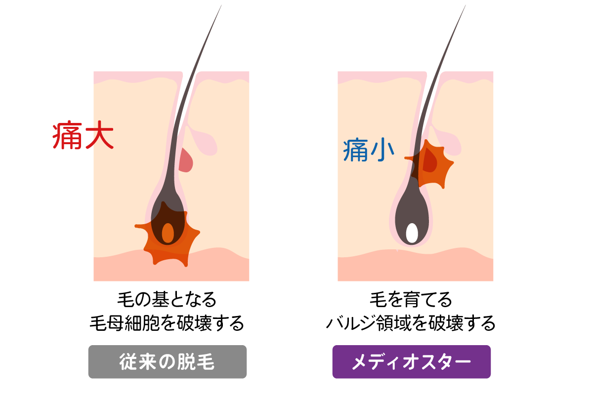 子供でもできる程の痛みの少なさ