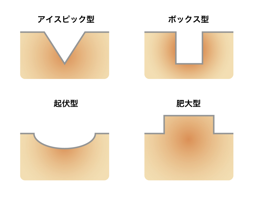 ニキビ跡の種類
