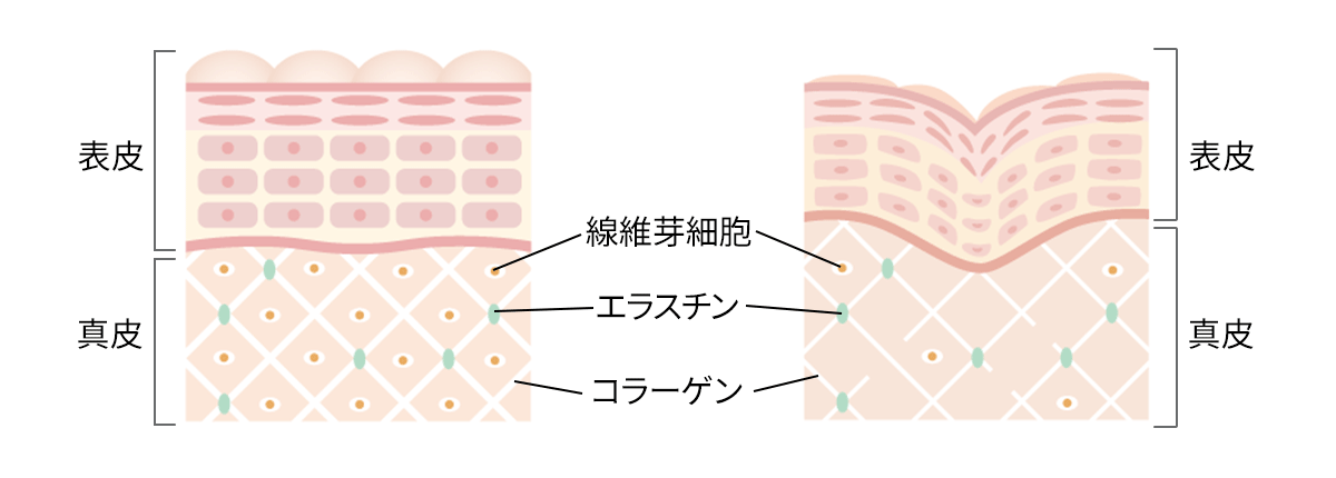 たるみ治療とは