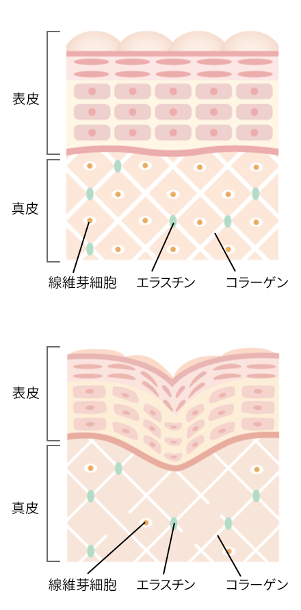 たるみ治療とは