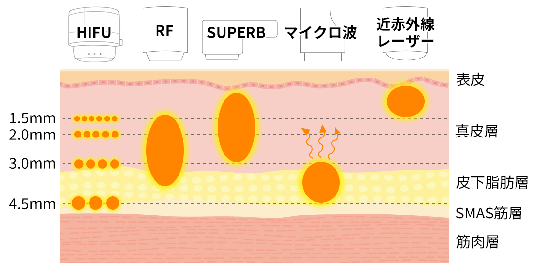 たるみ治療の種類