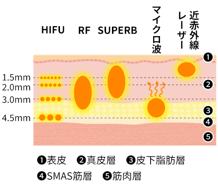 たるみ治療の種類