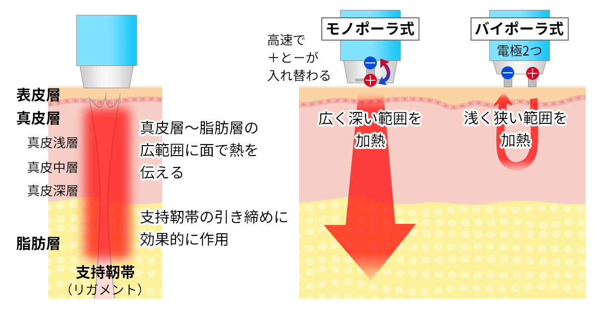 たるみ治療の種類