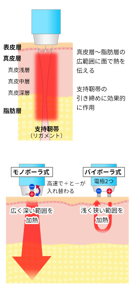 たるみ治療の種類