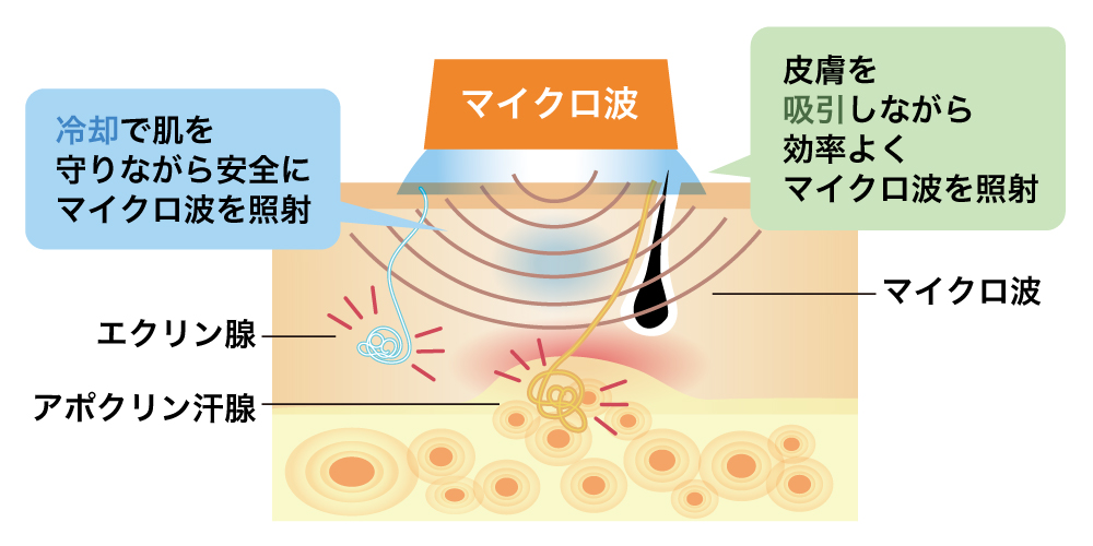 ミラドライの仕組み