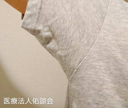 ミラドライ施術後