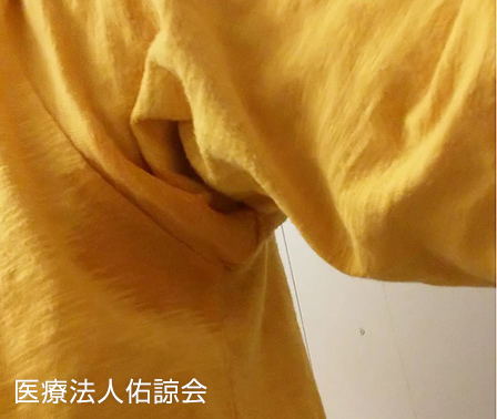 ミラドライ施術前