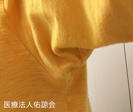 ミラドライ施術後