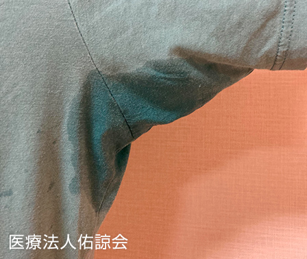 ミラドライ施術前