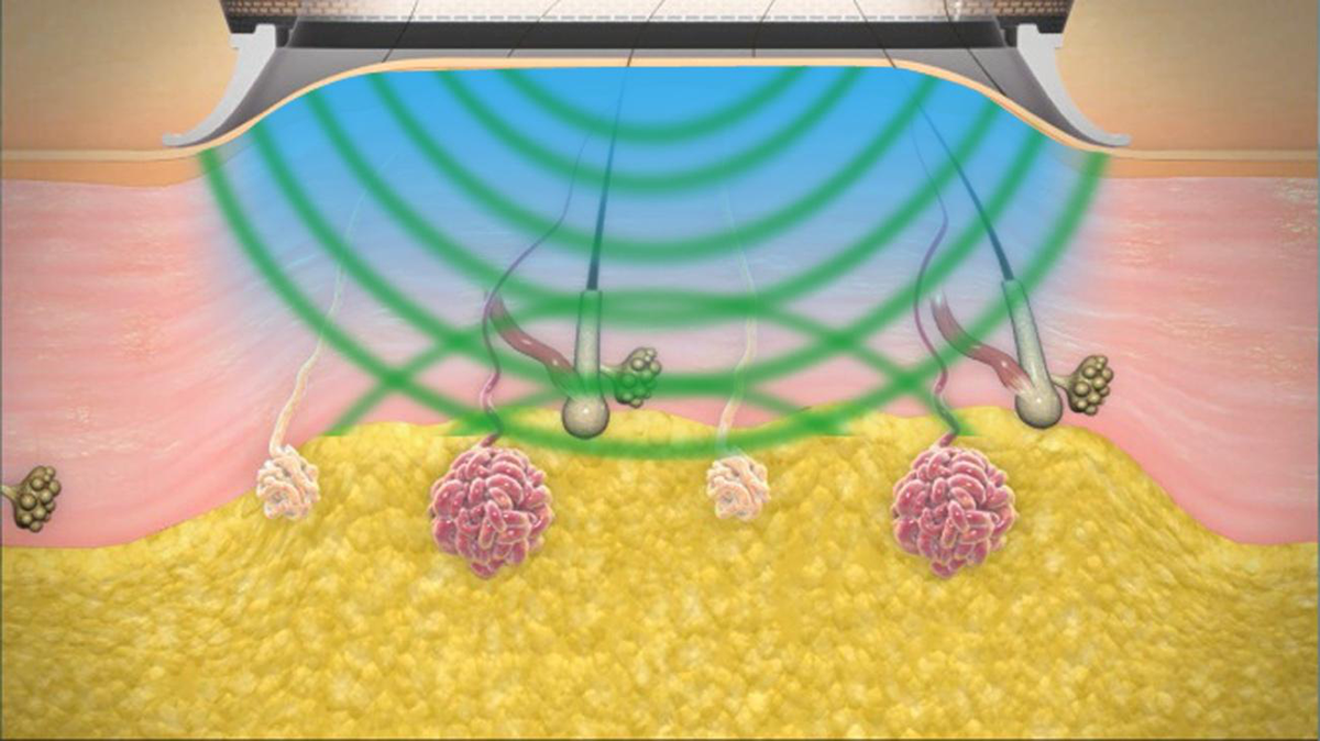 ミラドライの仕組み