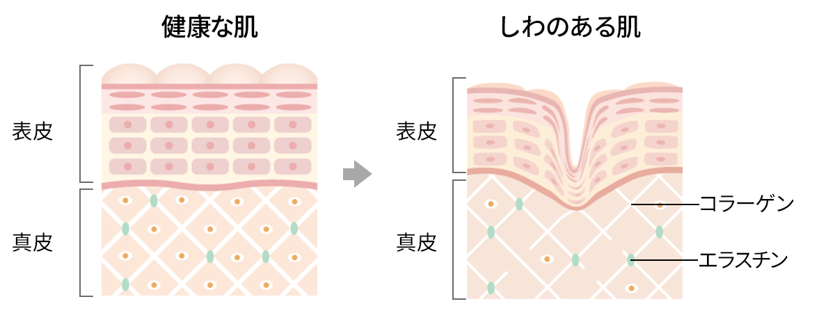 しわが出来る原因