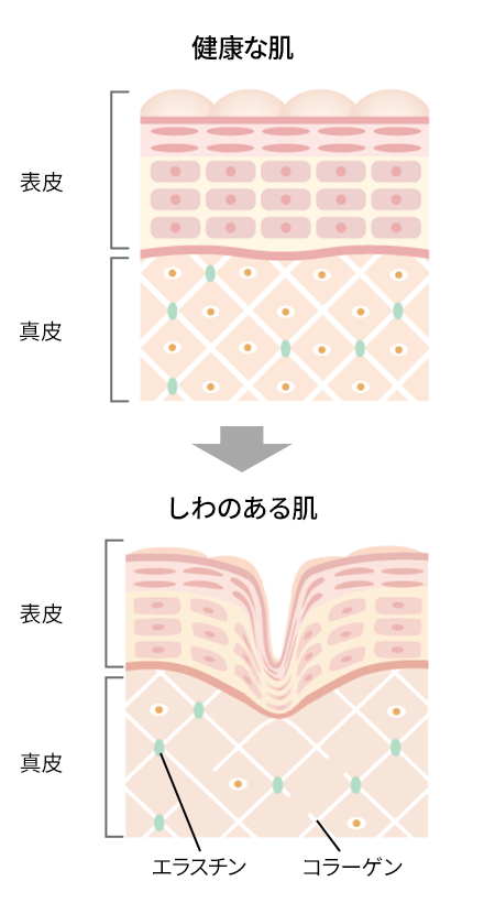 しわが出来る原因