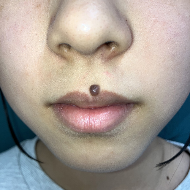 皮膚・皮下腫瘍摘出術施術前