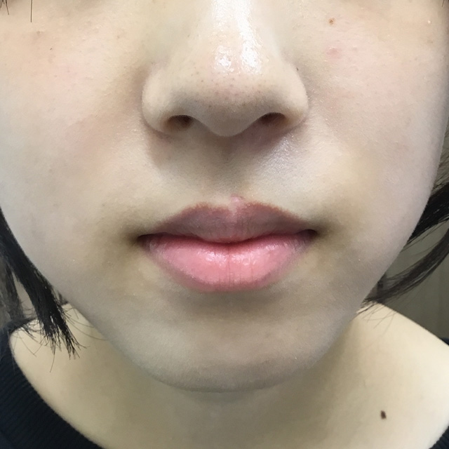 皮膚・皮下腫瘍摘出術施術後