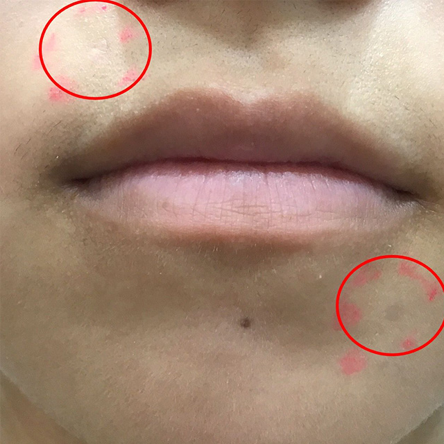 CO2レーザー施術後