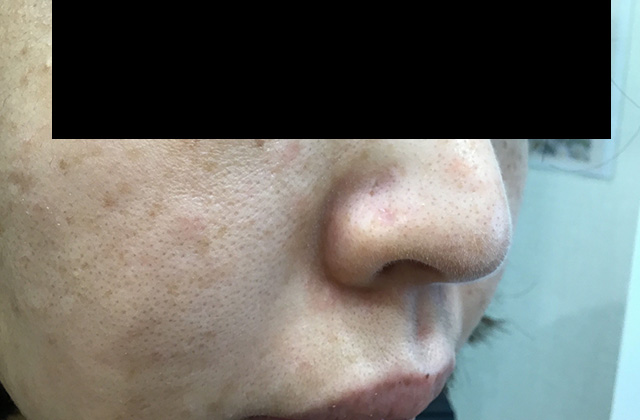 CO2レーザー施術後