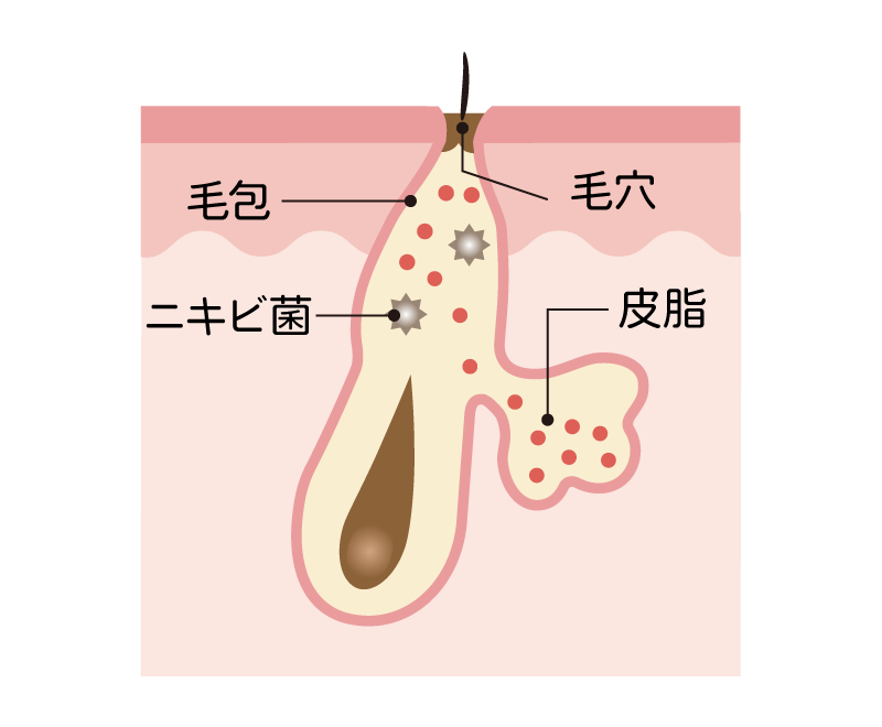 正常ニキビの断面図イラスト