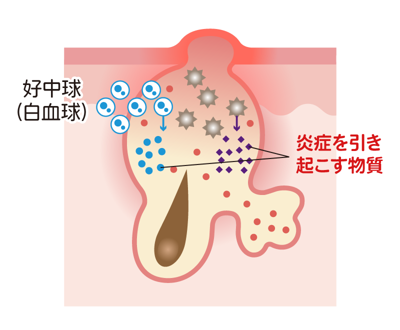 ばい菌がついて赤くなった赤ニキビ断面図イラスト