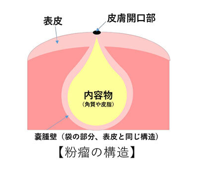 粉瘤　イメージ