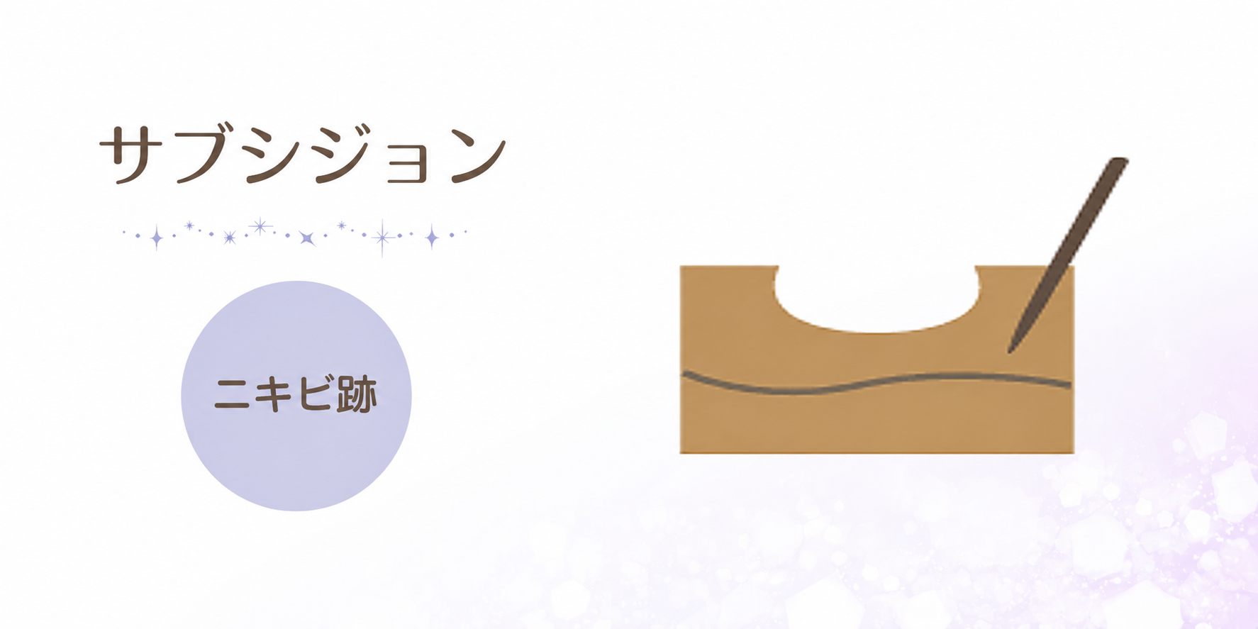サブシジョン ニキビ跡